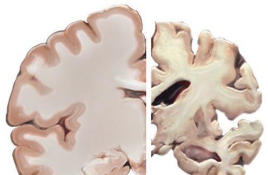 A healthy brain compared to a brain suffering from Alzheimer